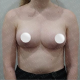 What is Internal Bra Lift Technique? Internal Bra Lift: More Durable Breast  Lift Technique in Delhi 