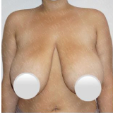 What is an Internal Bra Breast Lift and Reduction?