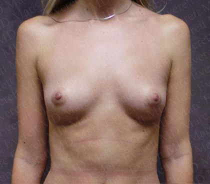 Breast Augmentation Before & After Patient #1923