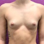 Breast Augmentation Before & After Patient #1746