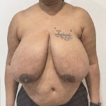Breast Reduction Before & After Patient #2244