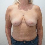 Breast Reduction Before & After Patient #2288