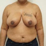 Breast Reduction Before & After Patient #2244