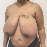 Breast Reduction Before & After Patient #2244