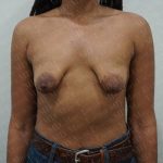 Tuberous Breast Surgery Before & After Patient #2053