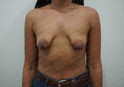 Tuberous Breast Surgery Before & After Patient #2053