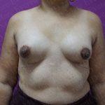 Tuberous Breast Surgery Before & After Patient #2052