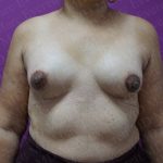 Tuberous Breast Surgery Before & After Patient #2052