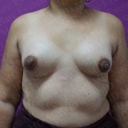 Tuberous Breast Surgery Before & After Patient #2052