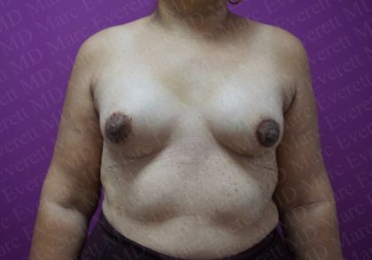 Tuberous Breast Surgery Before & After Patient #2052