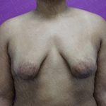 Tuberous Breast Surgery Before & After Patient #2051