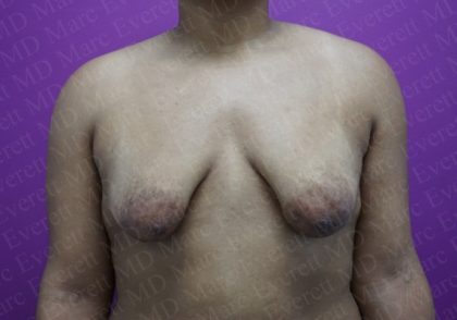 Tuberous Breast Surgery Before & After Patient #2051