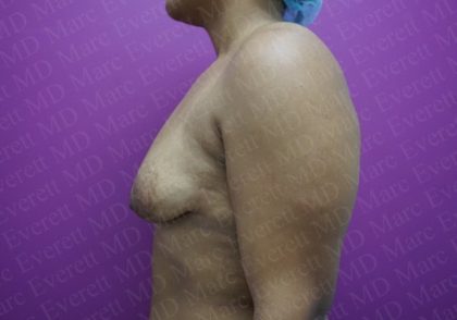 Tuberous Breast Surgery Before & After Patient #2051