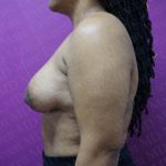 Tuberous Breast Surgery Before & After Patient #2051