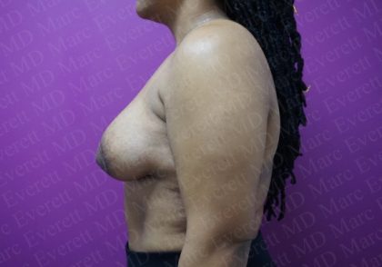 Tuberous Breast Surgery Before & After Patient #2051