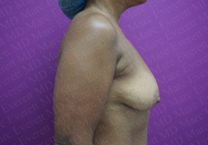 Breast Lift With Implant Before & After Patient #1998