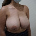 Breast Reduction Before & After Patient #231