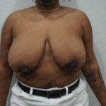 Breast Reduction Before & After Patient #1507