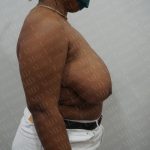 Breast Reduction Before & After Patient #1507