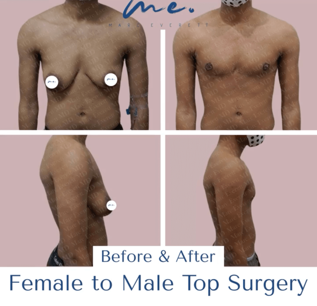 How to Get Top Surgery: Techniques, Costs, What to Expect, and More