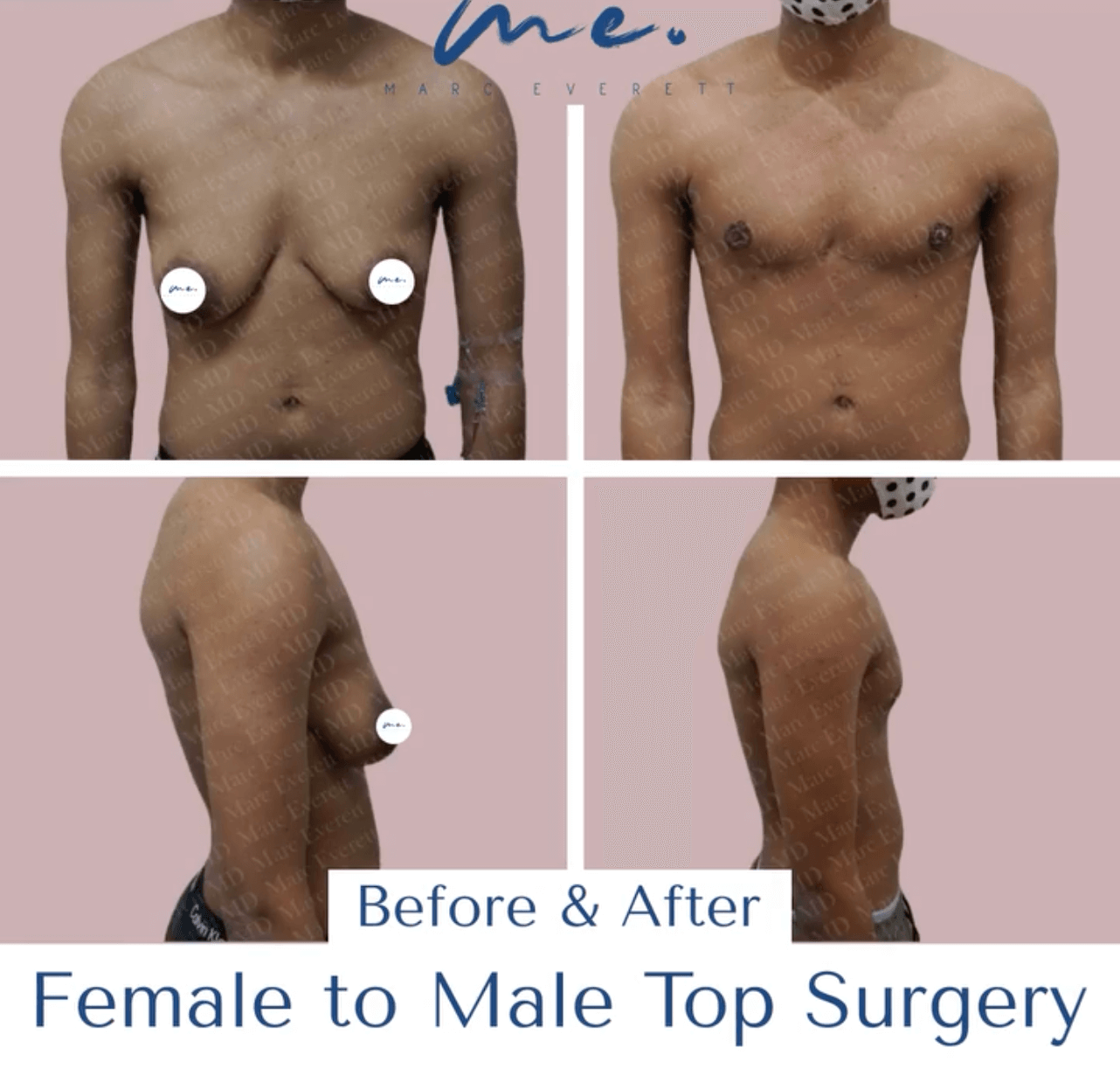 Top Surgery - Take Shape Plastic Surgery
