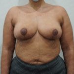 Breast Reduction Before & After Patient #2390