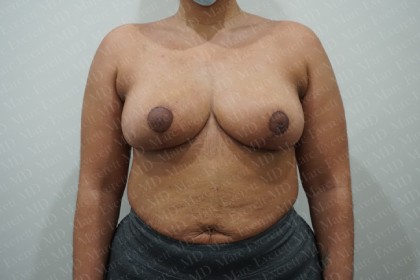 Breast Reduction Before & After Patient #2390