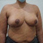 Breast Reduction Before & After Patient #2390