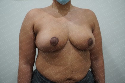 Breast Reduction Before & After Patient #2390