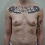 Breast Augmentation Before & After Patient #2501