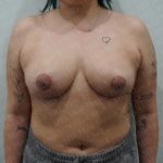 Breast Reduction Before & After Patient #2259