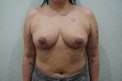 Breast Reduction Before & After Patient #2259