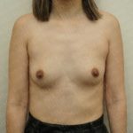 Breast Augmentation Before & After Patient #2474