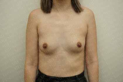 Breast Augmentation Before & After Patient #2474