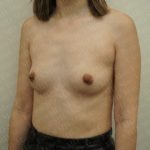 Breast Augmentation Before & After Patient #2474