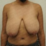 Breast Reduction Before & After Patient #2199