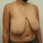 Breast Reduction Before & After Patient #2199