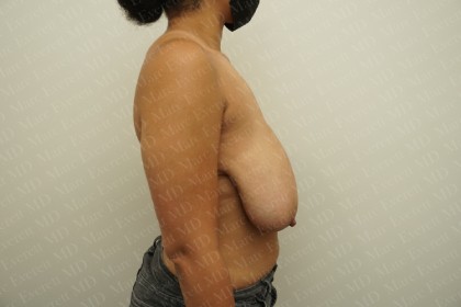 Breast Reduction Before & After Patient #2199