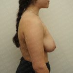 Breast Reduction Before & After Patient #2369