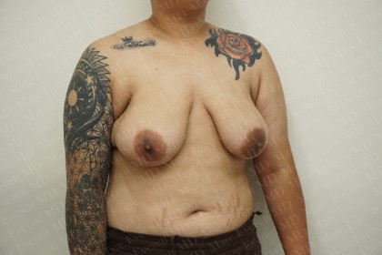 Breast Reduction Before & After Patient #2230