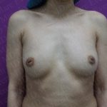 Breast Augmentation Before & After Patient #2490