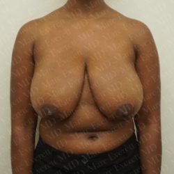 Breast Reduction Before & After Patient #2323