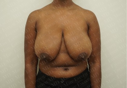 Breast Reduction Before & After Patient #2323