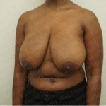 Breast Reduction Before & After Patient #2323