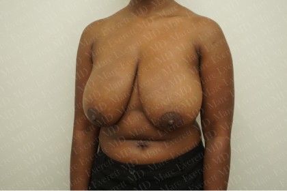 Breast Reduction Before & After Patient #2323