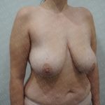 Breast Reduction Before & After Patient #2331