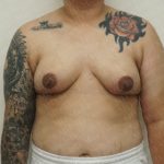 Breast Reduction Before & After Patient #2230