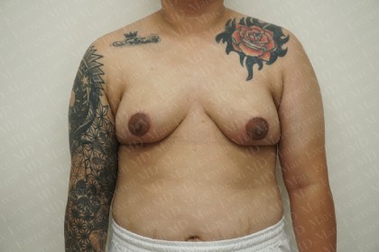 Breast Reduction Before & After Patient #2230