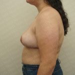 Breast Reduction Before & After Patient #2303