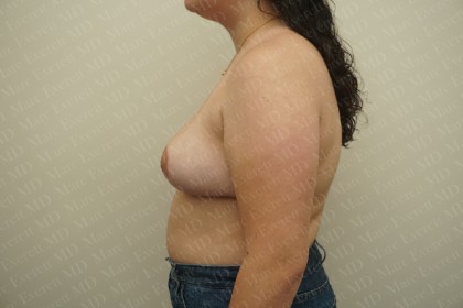 Breast Reduction Before & After Patient #2303